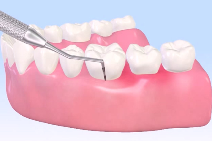 歯周病検査（6点法）